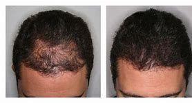 SE TE CALLO TU CABELLO, O ESTAS CALVO EN LA PARTE DE LAS SIENES ? AHORA ES POSIBLE TENER CABELLO. (947390722)