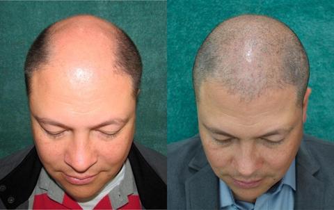 MICROPIGMENTACION DE CABELLO. (947390722)