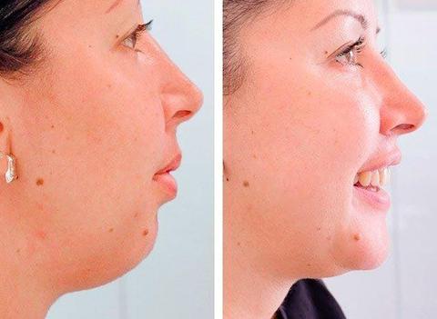ELIMINACION DE PAPADA Y PERFILADO DE ROSTRO. (947390722)