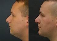 TRATAMIENTO PARA ELIMINAR LA PAPADA CON MESOTERAPIA. (947390722)